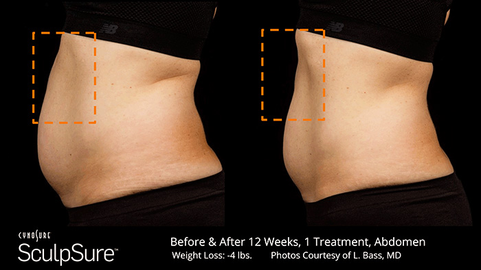before-and-after-sculpsure