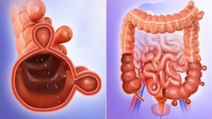 Diverticolosi e diverticolite del colon cause, evoluzione e terapie 