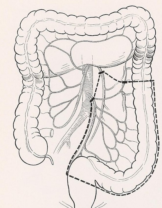 Diverticolosi e diverticolite del colon cause, evoluzione e terapie