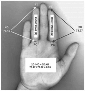 IIIV dito della mano curiosità epigenetica e significato andrologico
