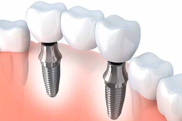 Chirurgia Implantare, tante soluzioni per recuperare una dentatura funzionale