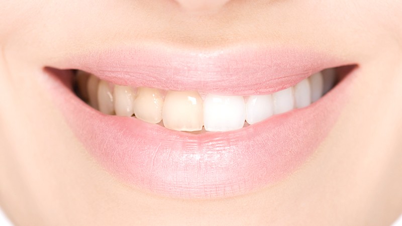 Denti bianchi dai rimedi fai da te ai trattamenti professionali