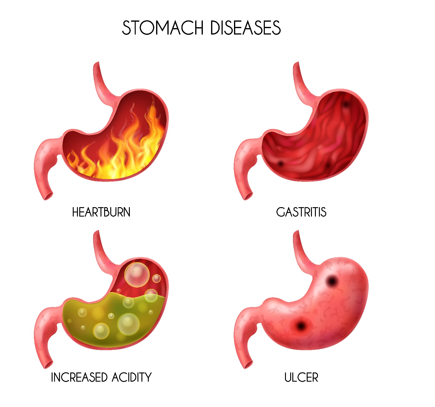 Acidità di stomaco cause e prevenzione (2)