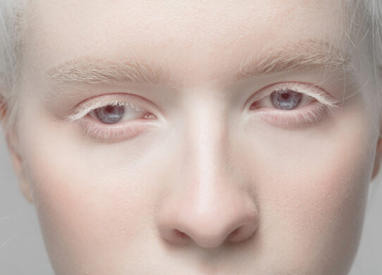 Albinismo e occhi Cos’è l’albinismo