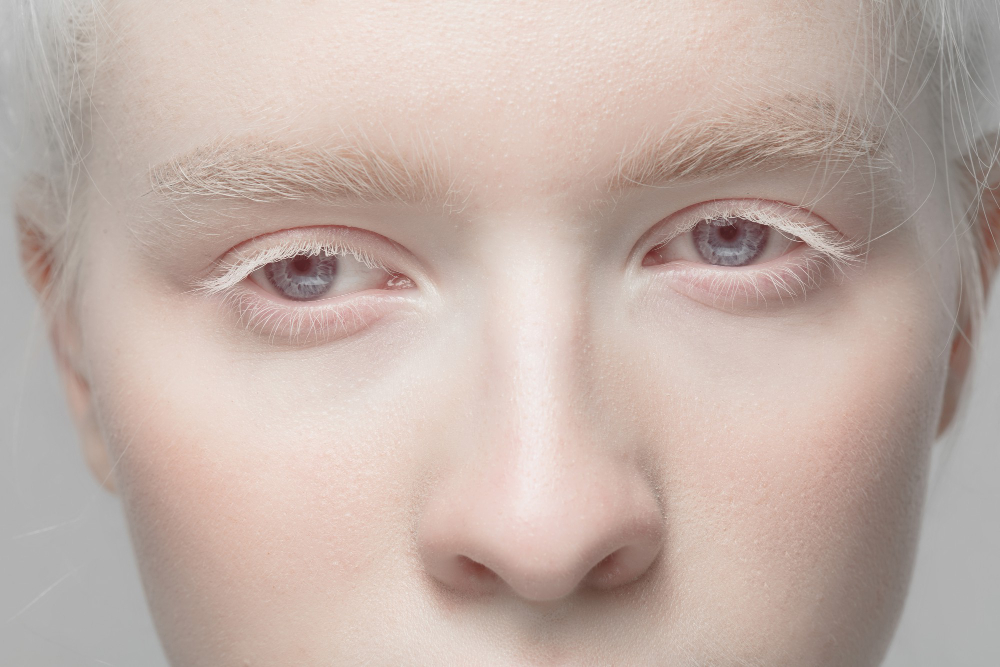 Albinismo e occhi Cos’è l’albinismo