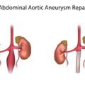 Aneurisma dell’aorta addominale: cos’è, trattamento e diagnosi