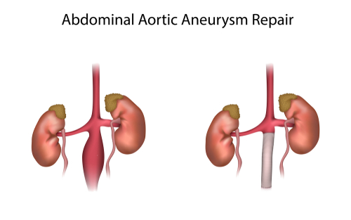 Aneurisma dell’aorta addominale: cos’è e trattamento
