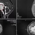Bambina di 18 mesi operata per tumore raro al cervello