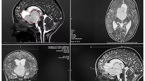Bambina di 18 mesi operata per tumore raro al cervello