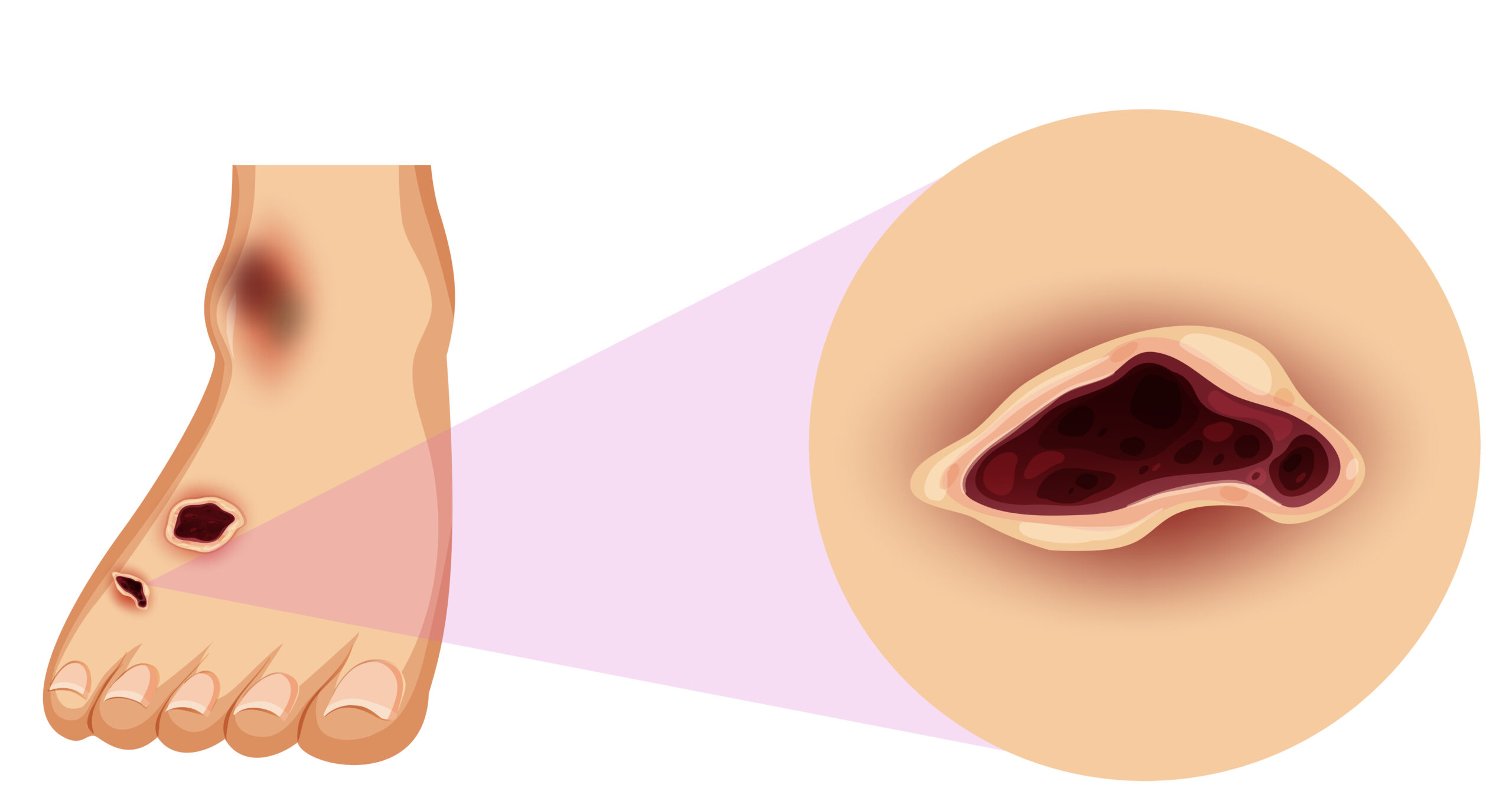 Cause delle ulcere agli arti inferiori: approccio clinico