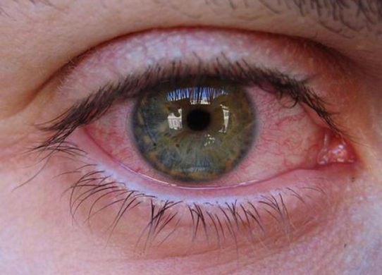 Congiuntivite da coronavirus occhi fonte di contagio