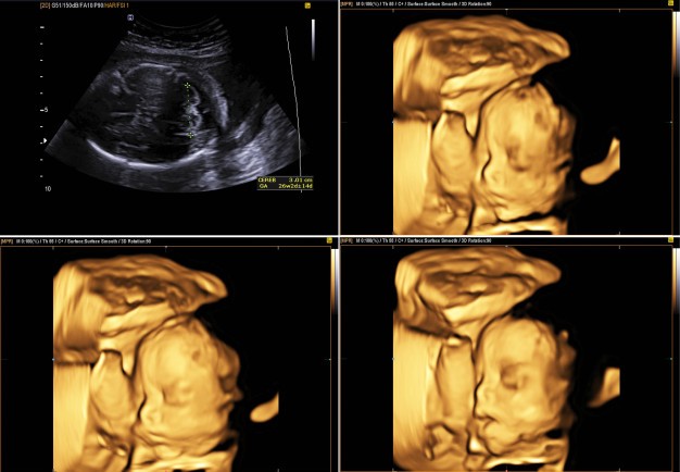 Controlli in gravidanza l’ecografia 3D-4D