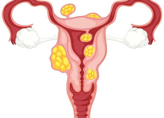 Cosa sono i fibromi uterini?