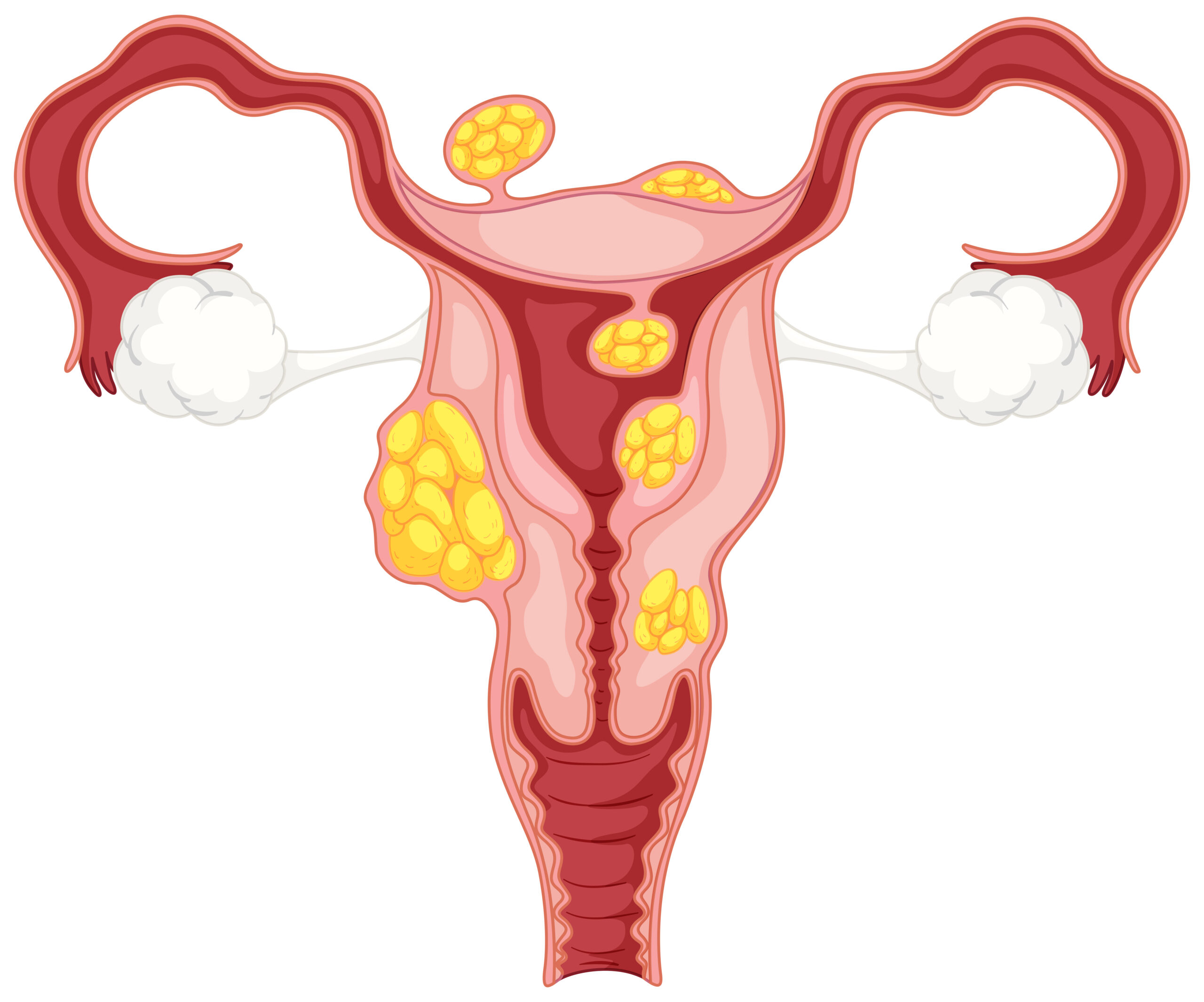 Cosa sono i fibromi uterini?