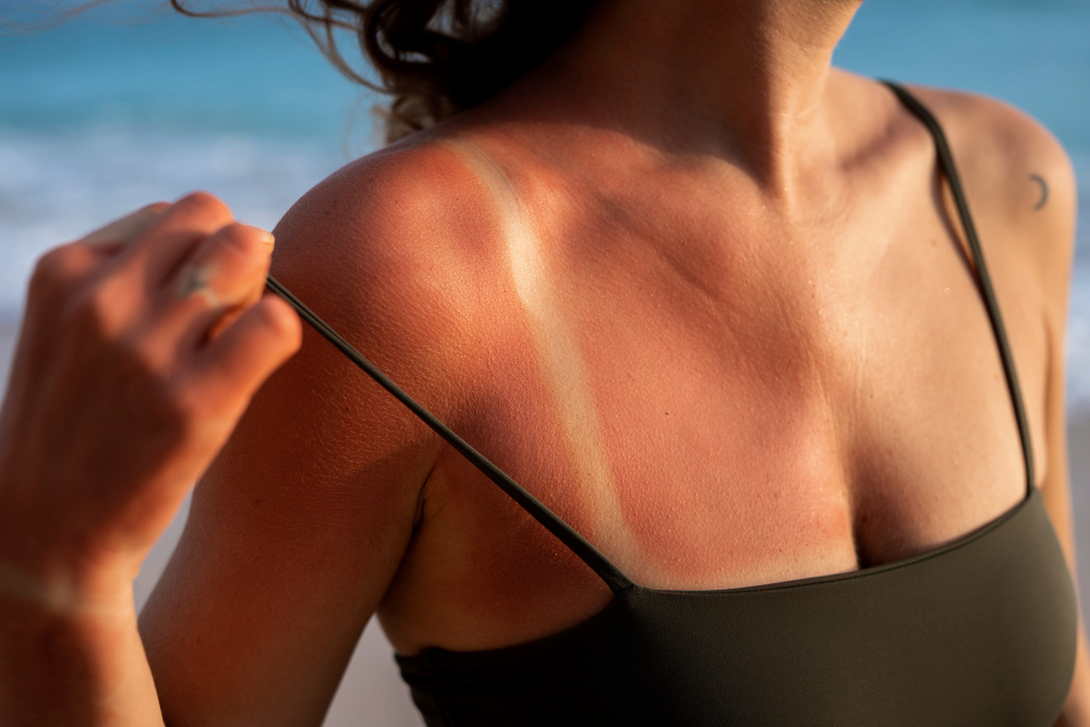 Cura della pelle dopo esposizione al sole: consigli essenziali per una pelle sana e luminosa