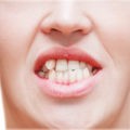 Denti storti cause e trattamenti