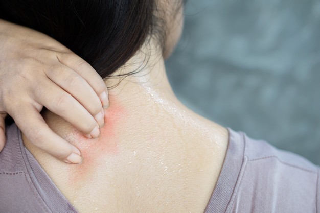 Dermatite da sudore attenzione alla pelle quando si fa sport
