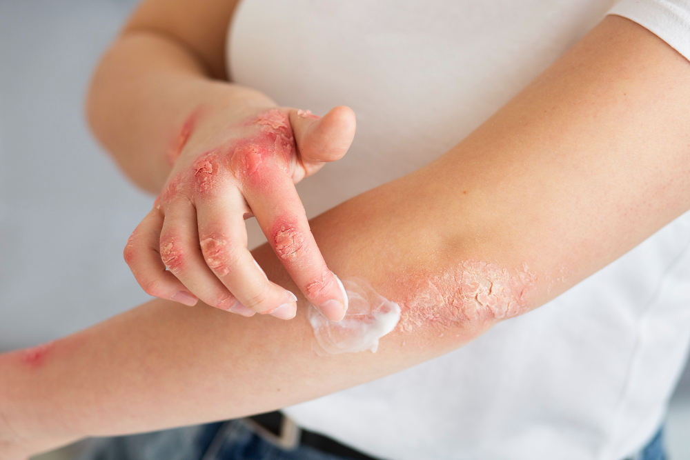 Eczema: sintomi, cause e terapie