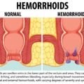 Emorroidi ragadi e fistole guida completa a sintomi cause e trattamenti efficaci