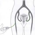 Fibroma uterino quanto è importante l’esperienza del chirurgo