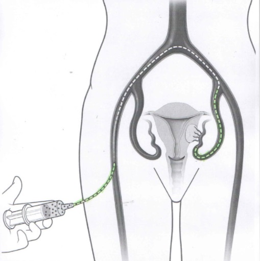 Fibroma uterino: quanto è importante l’esperienza del chirurgo