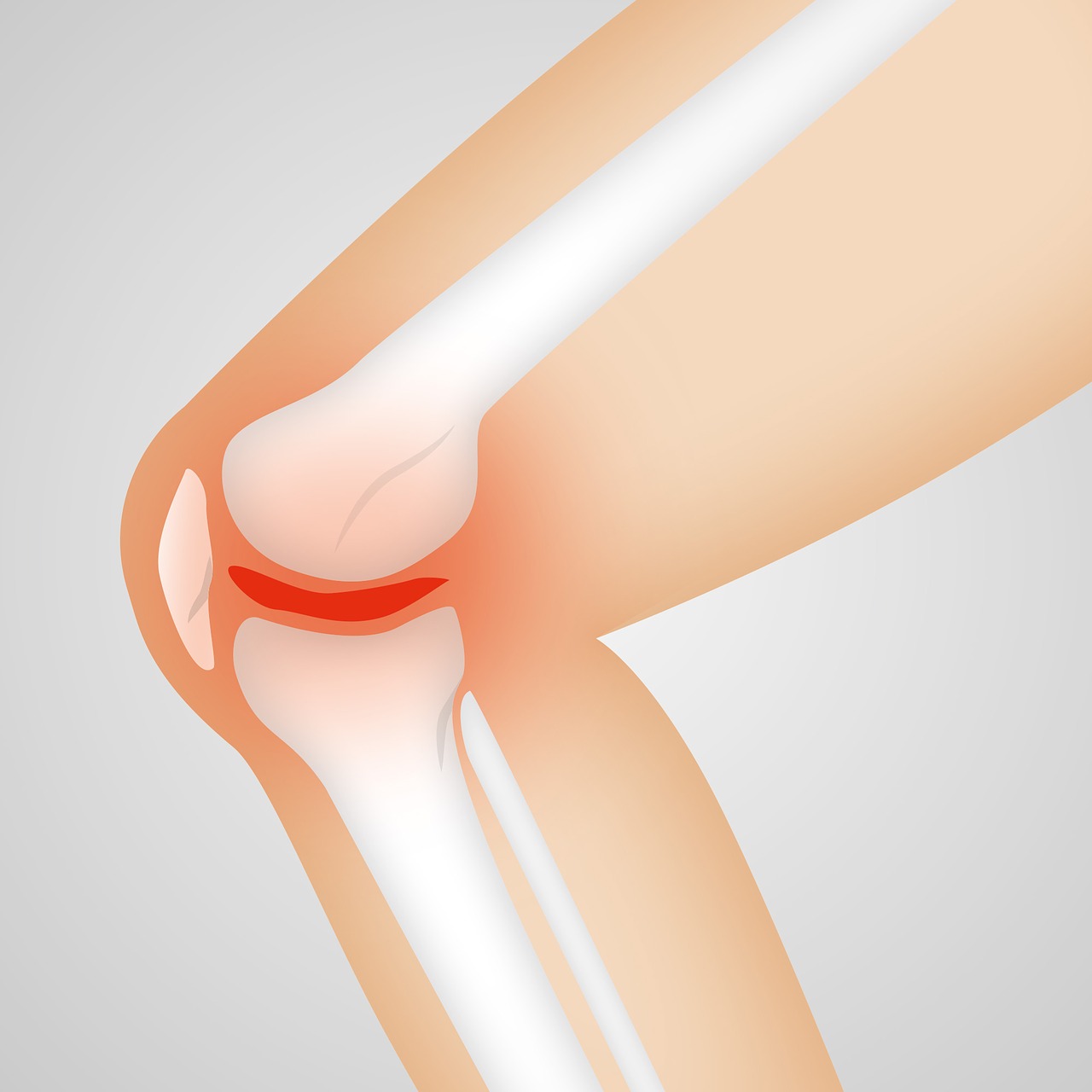 Gonalgia: quell’improvviso dolore al ginocchio