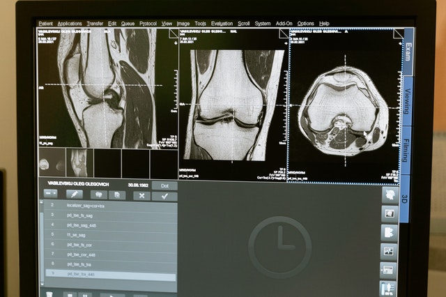 Gonartrosi dagli USA arriva l'embolizzazione del ginocchio che permette di guarire senza bisturi