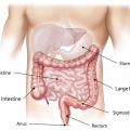 I tumori del colon retto cause, sintomi, trattamento