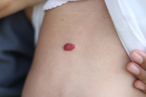 I tumori maligni della cute e dei tessuti molli sottocutanei, non-melanomi