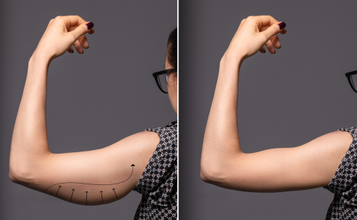 Il lifting delle braccia: quando farlo?