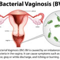 Il vaginismo sintomi e terapie