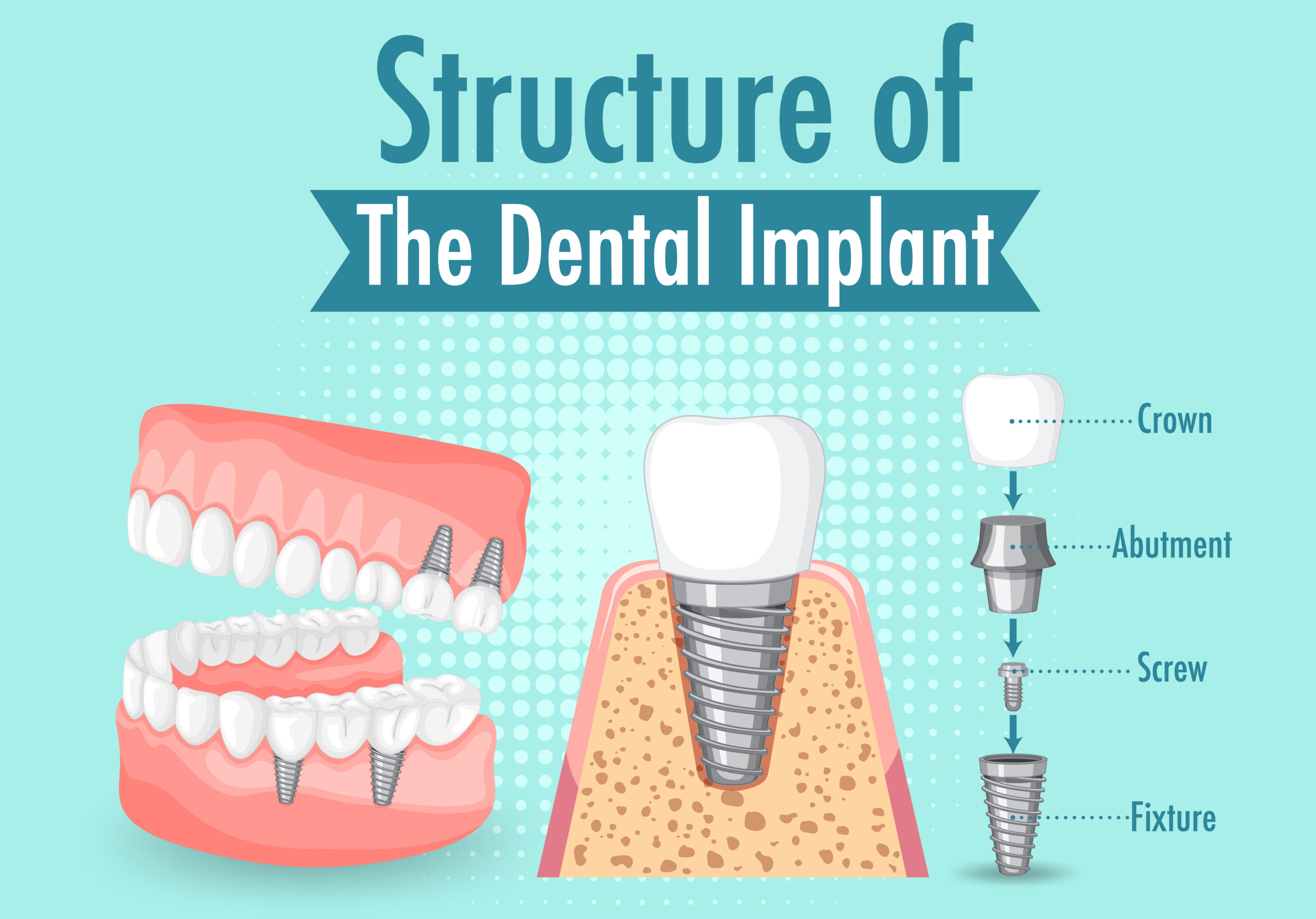 Implantologia dentale cos’è e quando è necessaria