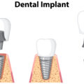 L'Impianto Dentale Singolo: Una Soluzione Avanzata per il Ripristino del Dente Mancante