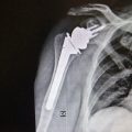 La patologia artrosica della spalla ed il trattamento chirurgico di protesi inversa