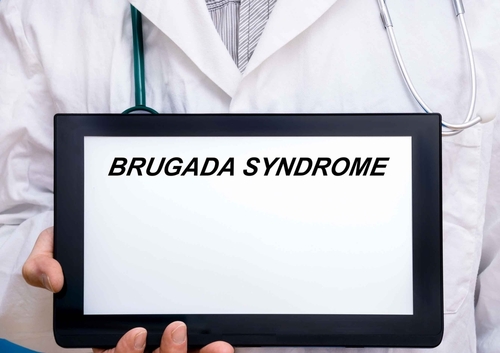 La sindrome di Brugada, in cosa consiste e come si presenta