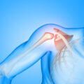 Lesione della cuffia dei rotatori della spalla cause sintomi e trattamenti efficaci