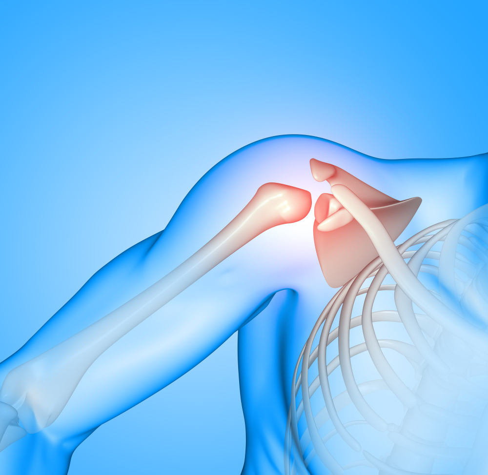 Lesione della cuffia dei rotatori della spalla: cause sintomi e trattamenti efficaci