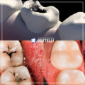 Otturazione dentale Riparazione efficace per la salute dei denti