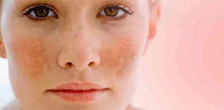 Reverse Peel: soluzione alle macchie da melasma 