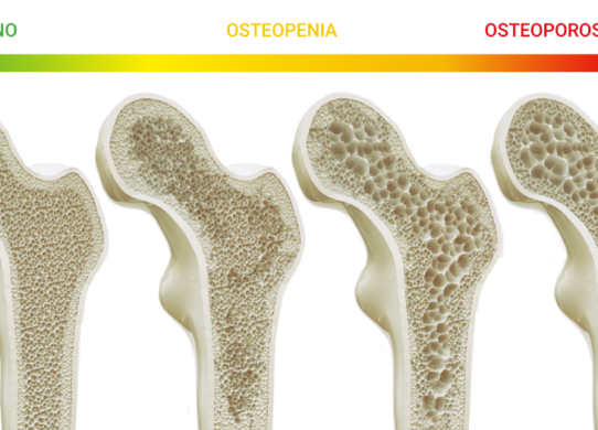 Screening gratuito per verificare la predisposizione allo sviluppo dell’osteoporosi