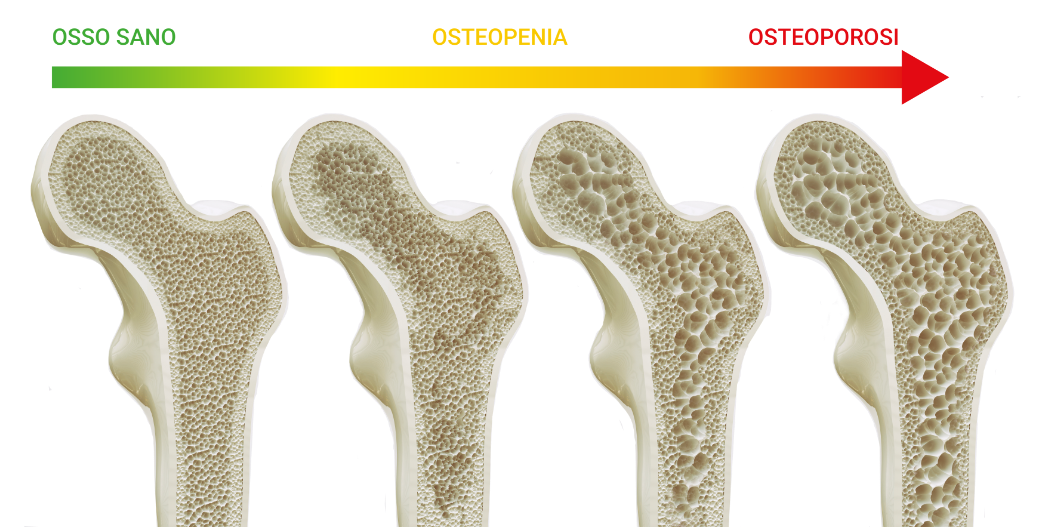Screening gratuito per verificare la predisposizione allo sviluppo dell’osteoporosi
