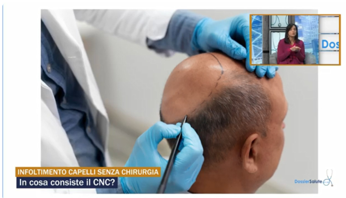 Infoltimento capelli senza chirurgia: intervista alla dr.ssa Fiorella Araniti, responsabile CR LAB